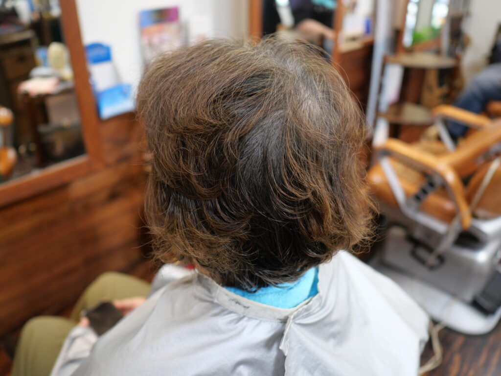 抗がん剤治療で脱毛